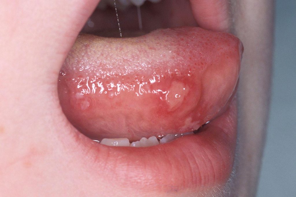 Các nốt loét trong miệng là dấu hiệu thường gặp khi trẻ mắc tay chân miệng.